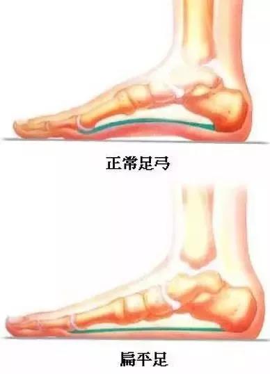 扁平足的危害怎么形成的,扁平足的危害和治疗方法