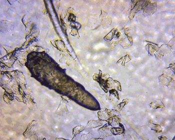 脸上有螨虫怎么快速消除,脸上有螨虫需要怎么注意