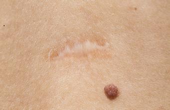 色素痣有什么危害,色素痣的处理原则及治疗的优缺点