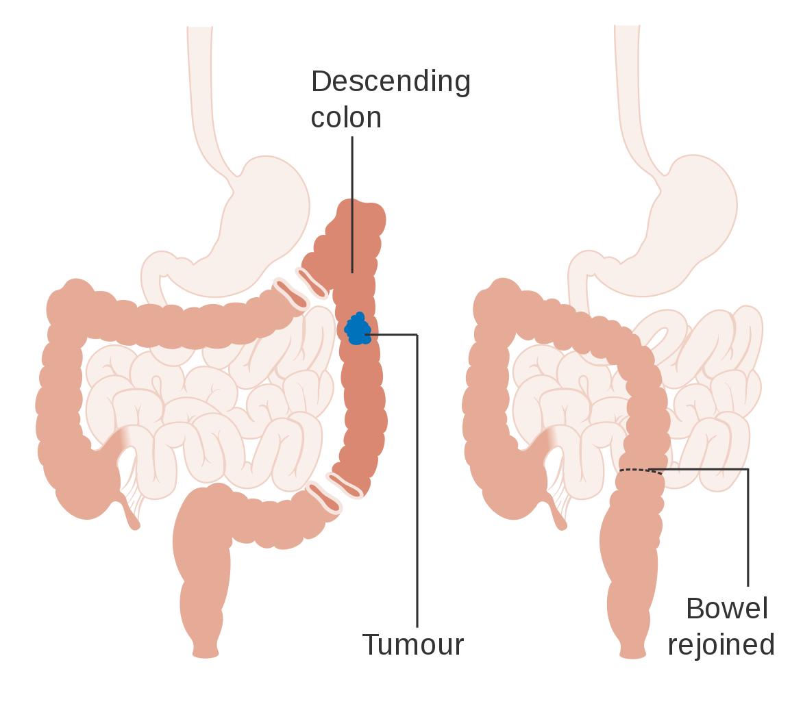 肠癌晚期腹腔转移肠梗阻如何造口,肠癌引起肠梗阻能治愈吗