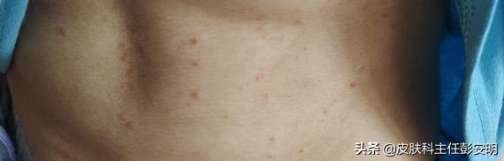 银屑病抗争经历,我与鱼鳞病的抗争