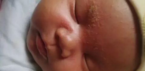 婴儿干性湿疹抹护肤品没有激素,宝宝湿疹要选抗过敏保湿护肤品
