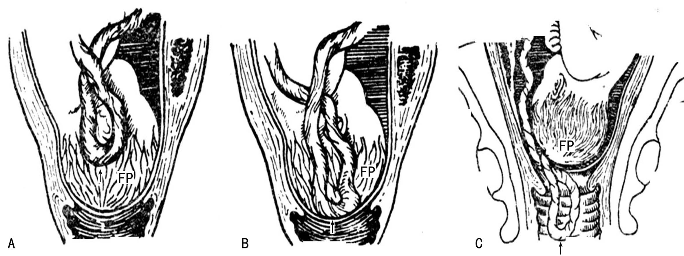如何知道脐带脱垂,如何发现脐带脱垂