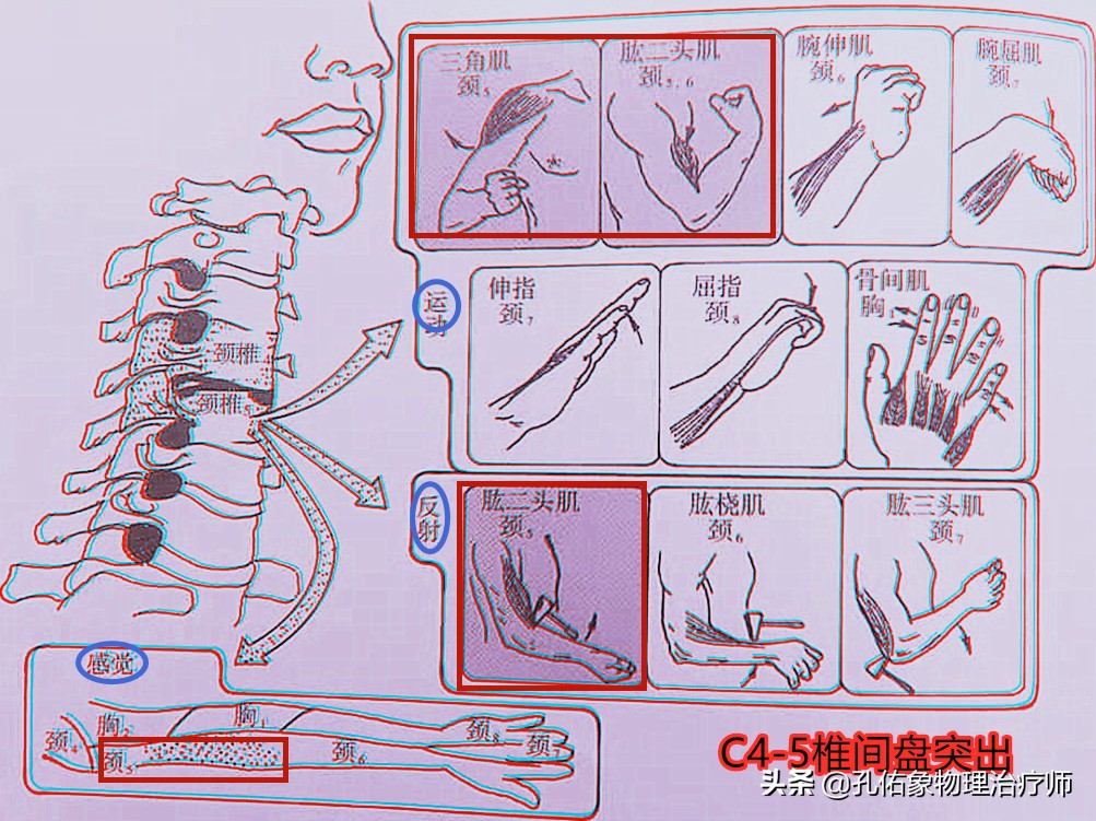 颈椎间盘突出手指尖麻乏力怎么治,颈椎间盘突出导致四肢无力疼痛