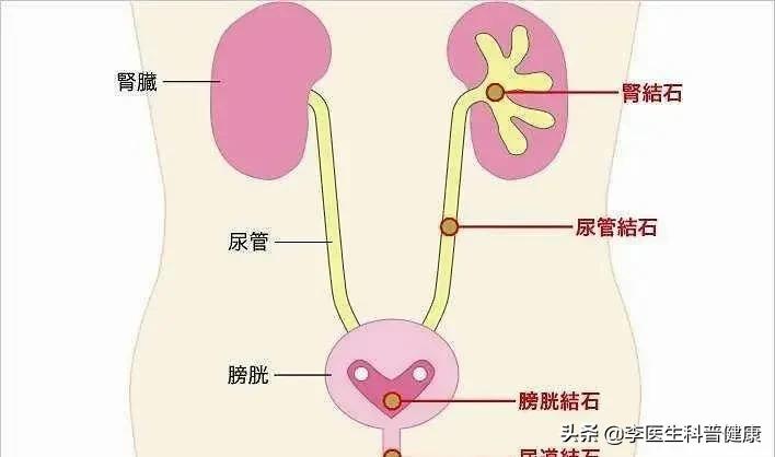 肾结石导致腰痛,肾结石引起的腰痛有哪些特点