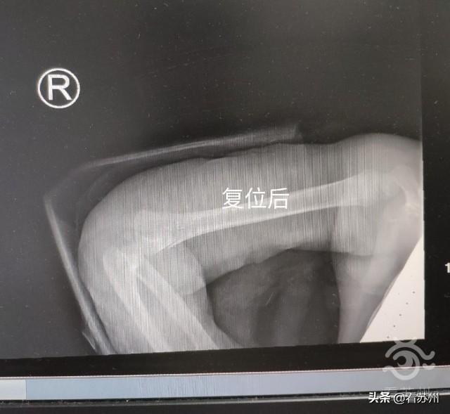小女孩骨折神奇复位视频,骨折女孩正骨复位