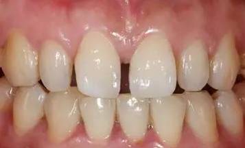 牙缝越来越大是什么导致的,牙缝越来越大什么病中医怎么说