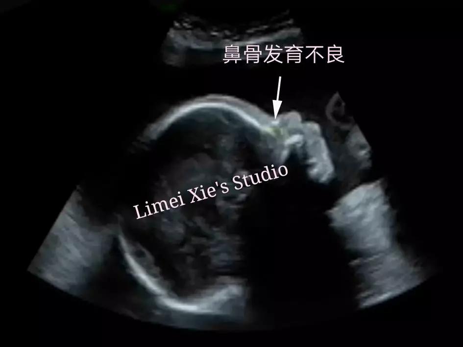 唐氏儿鼻骨是缺失还是发育不良,20周胎儿一侧鼻骨缺失或发育不良
