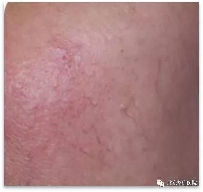 光子嫩肤唤醒肌肤活力重塑娇颜,光子嫩肤让你焕颜一新