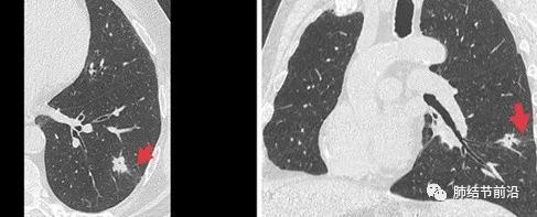 肺癌气道播散转移的症状,肺癌胸膜腔转移
