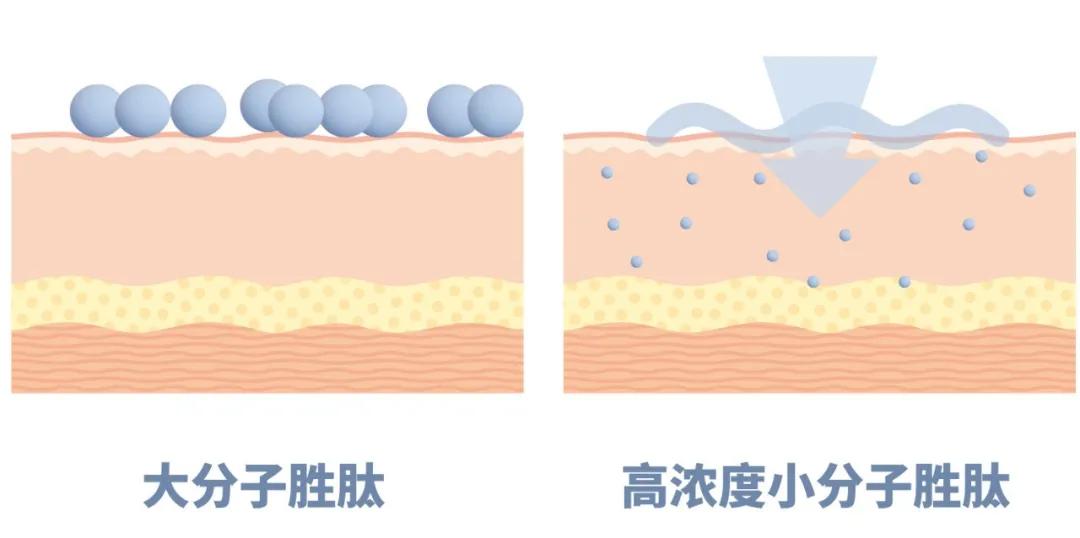 眼纹小熨斗,淡化眼纹小熨斗