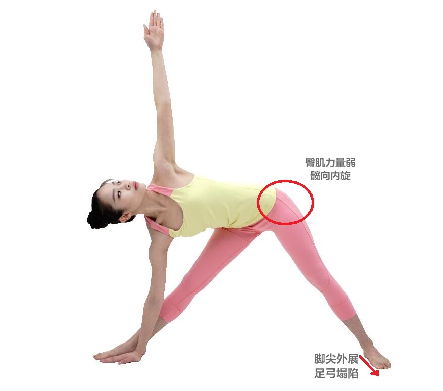 小腿外侧粗改善动作,小腿外扩和小腿外翻用什么矫正