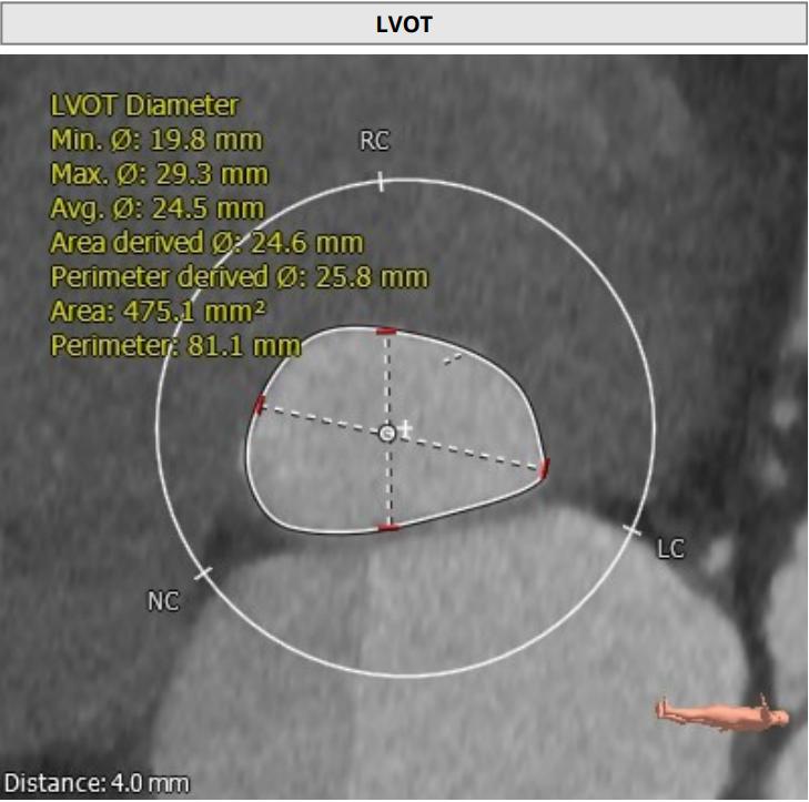 微创人工主动脉瓣膜置换术,微创介入主动脉瓣膜置换术