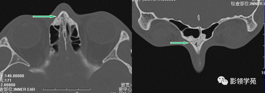 鼻骨影像学解剖,鼻骨解剖及骨折影像学诊断