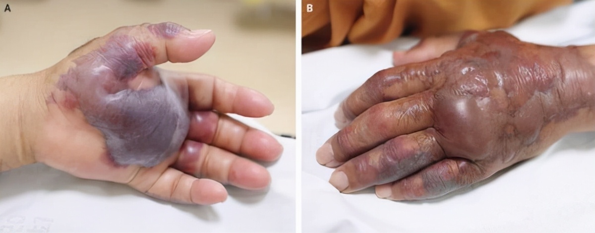 老人洗虾手指遭刺被迫截肢保命,洗虾被扎手多大概率死亡