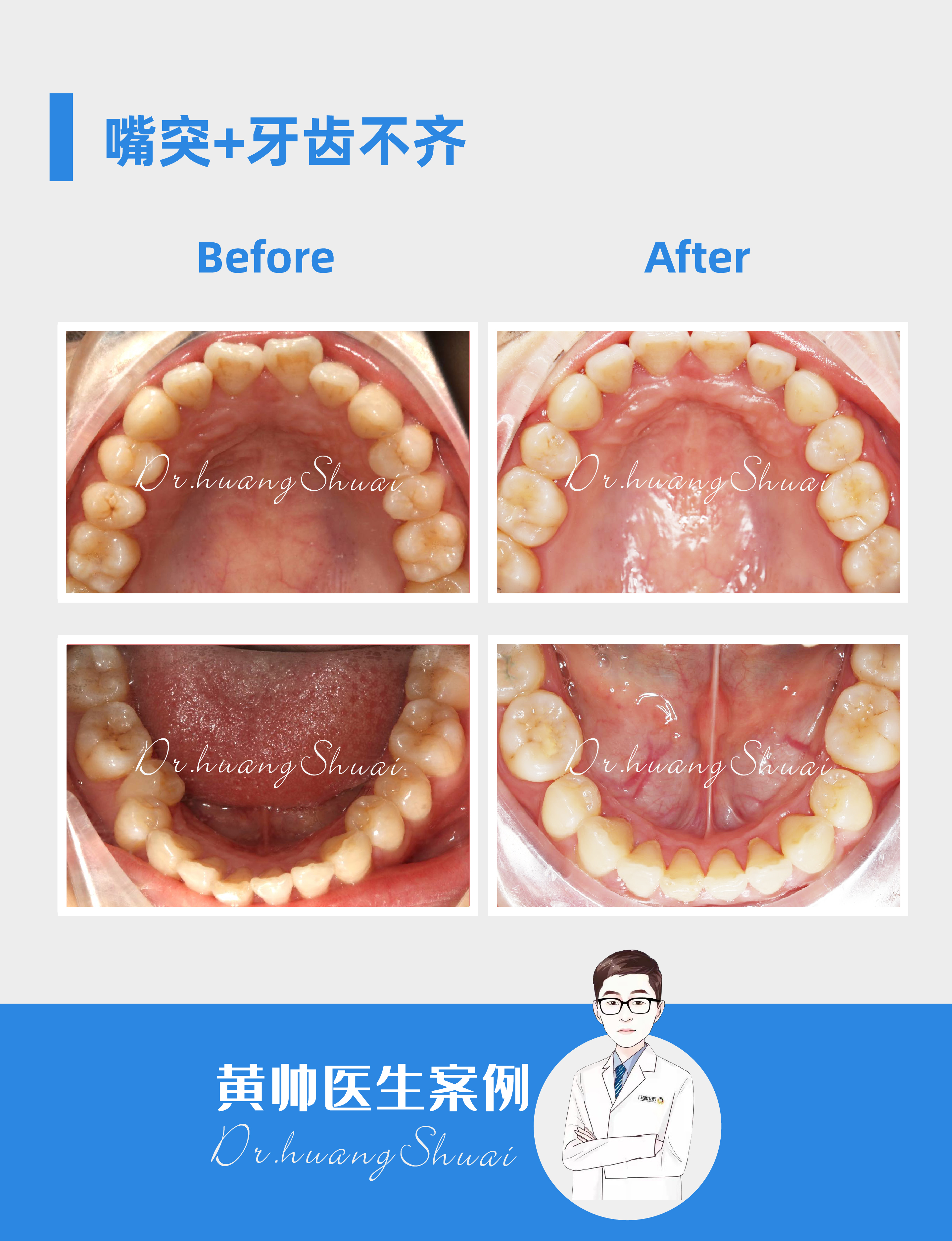 嘴凸牙齿矫正前后对比视频,牙齿矫正拔智齿可以怎样改善嘴凸