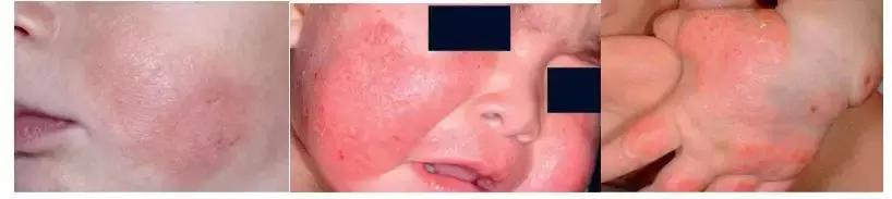 婴幼儿湿疹如何护理崔玉涛,简述婴幼儿湿疹的护理措施