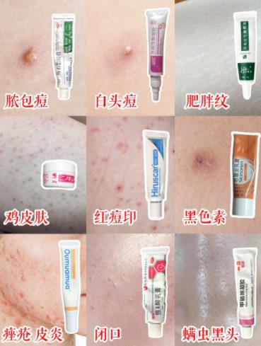 痘痘闭口药膏,闭口黑头痘痘药膏推荐