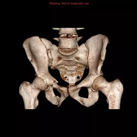 几种严重骨折医学名称,常见的骨折有哪些名称