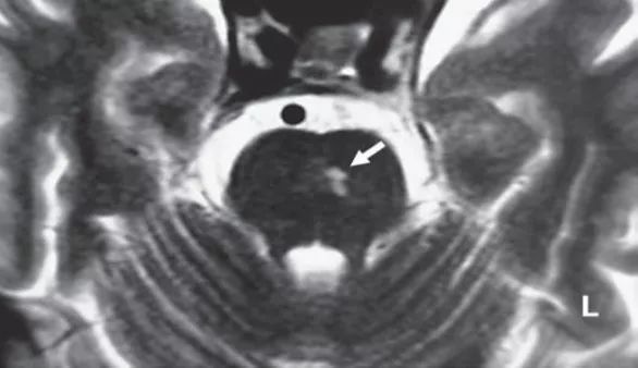 上跳性眼震能自愈吗,位置性眼震及眩晕