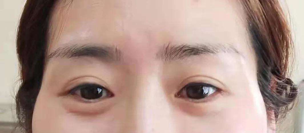 中山哪里假体填充太阳穴,假体填充太阳穴哪里可以做