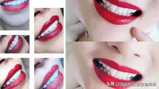 烤瓷牙颜色太黄了怎么办,烤瓷牙变黄了怎么变白