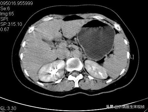 肝上有结节是血管瘤吗,肝上有结节有可能是肝炎吗