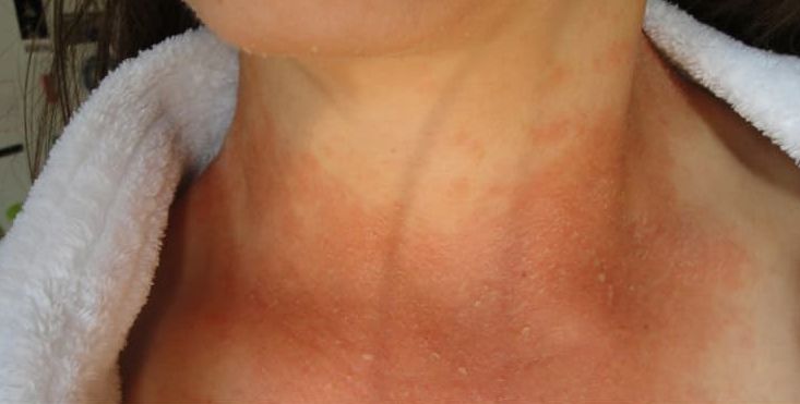 老是莫名其妙真菌感染,总是真菌感染是因为什么