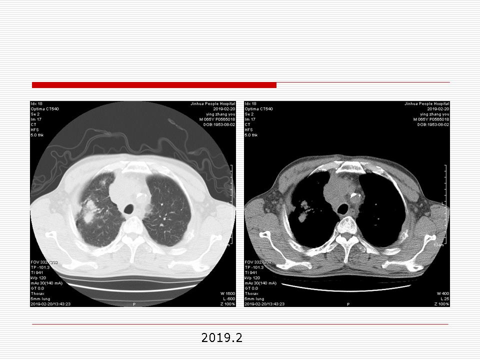 像炎症的肺癌能治好吗,医生说可能是肺癌也可能是炎症