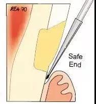 楔状缺损坑,较深的楔状缺损