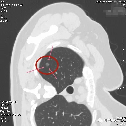 怎样从病理报告看是不是原位癌,原位腺癌切除子宫要开刀吗