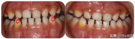 狗狗乳牙地包天怎么办,儿童乳牙地包天怎么办