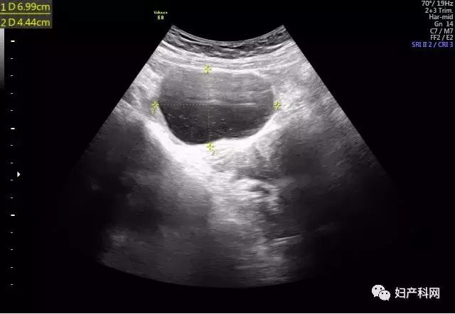 超声介入消融治疗卵巢囊肿,微无创治疗子宫肌瘤过程