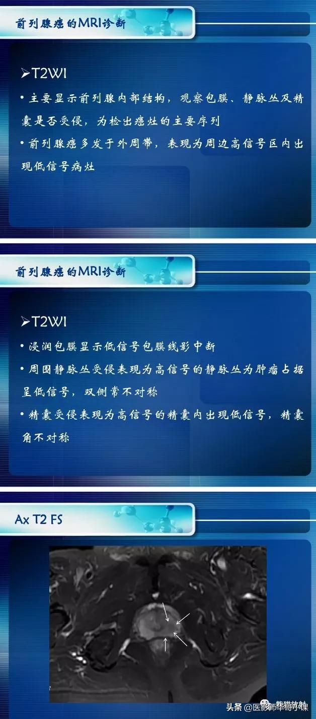 前列腺磁共振影像解剖,前列腺mri正常诊断报告模板