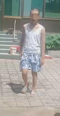 开颅手术后颅内细菌感染图片,外伤开颅手术后脑积液能恢复吗