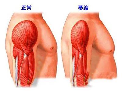 肌肉萎缩的病人是什么样,肌肉萎缩症的人