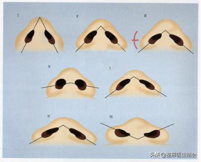 鼻翼缩小外切好吗,鼻翼缩小外切还是内切效果好