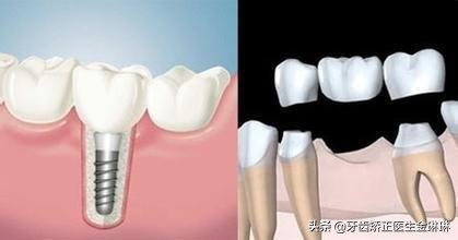 为什么做假牙就牙痛,镶牙几年后假牙下的真牙疼怎么办