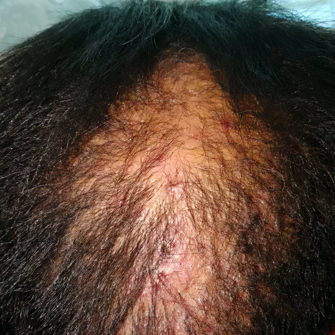 靶向药物导致皮疹的护理,靶向药造成的肌肉损伤能自愈吗