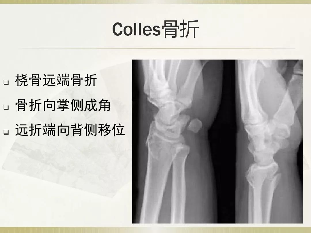 骨科x光片读片技巧,放射科骨科读片教程