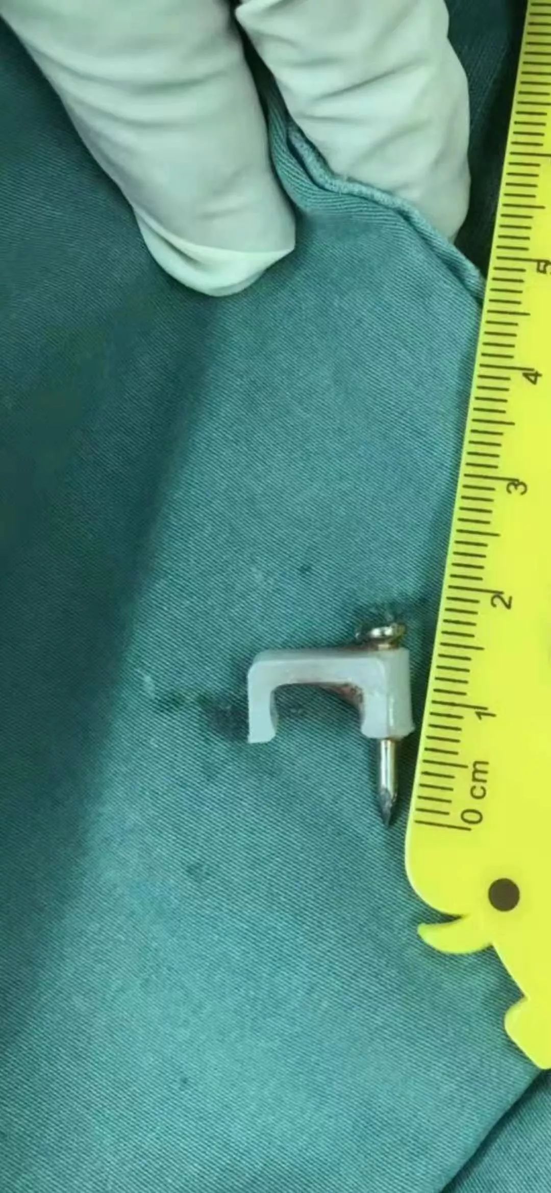 吞下“网线钉”浑然不觉，福州闽侯4岁男孩命悬一线