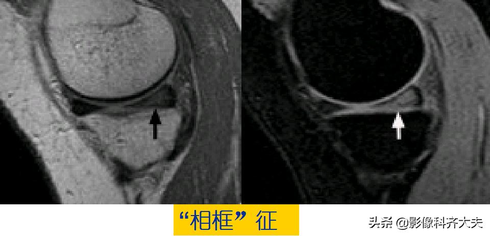 膝关节半月板损伤的磁共振,膝关节半月板病变的mri诊断与鉴别