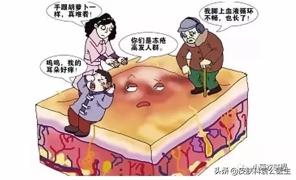 冻疮后期接触水干燥发痒怎么治,冻伤痒痛