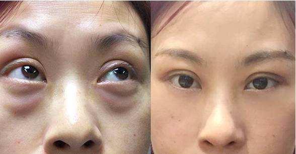 如何消除眼袋拥有卧蚕,眼袋和眼纹哪个好去除