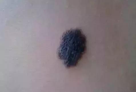 宝宝屁股上的青色印记是怎么回事,宝宝屁股上有青斑是怎么回事