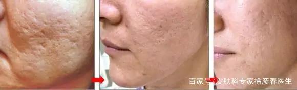 疱疹后遗症怎么治,疮疤留下的黑印怎么消除