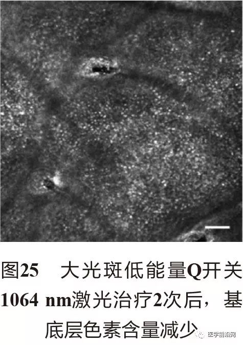 皮肤共聚焦显微镜能查什么,皮肤镜和共聚焦显微镜