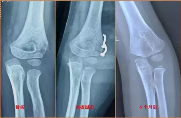 人的胳膊肘都是往里拐的,胳膊肘往里拐是什么原因