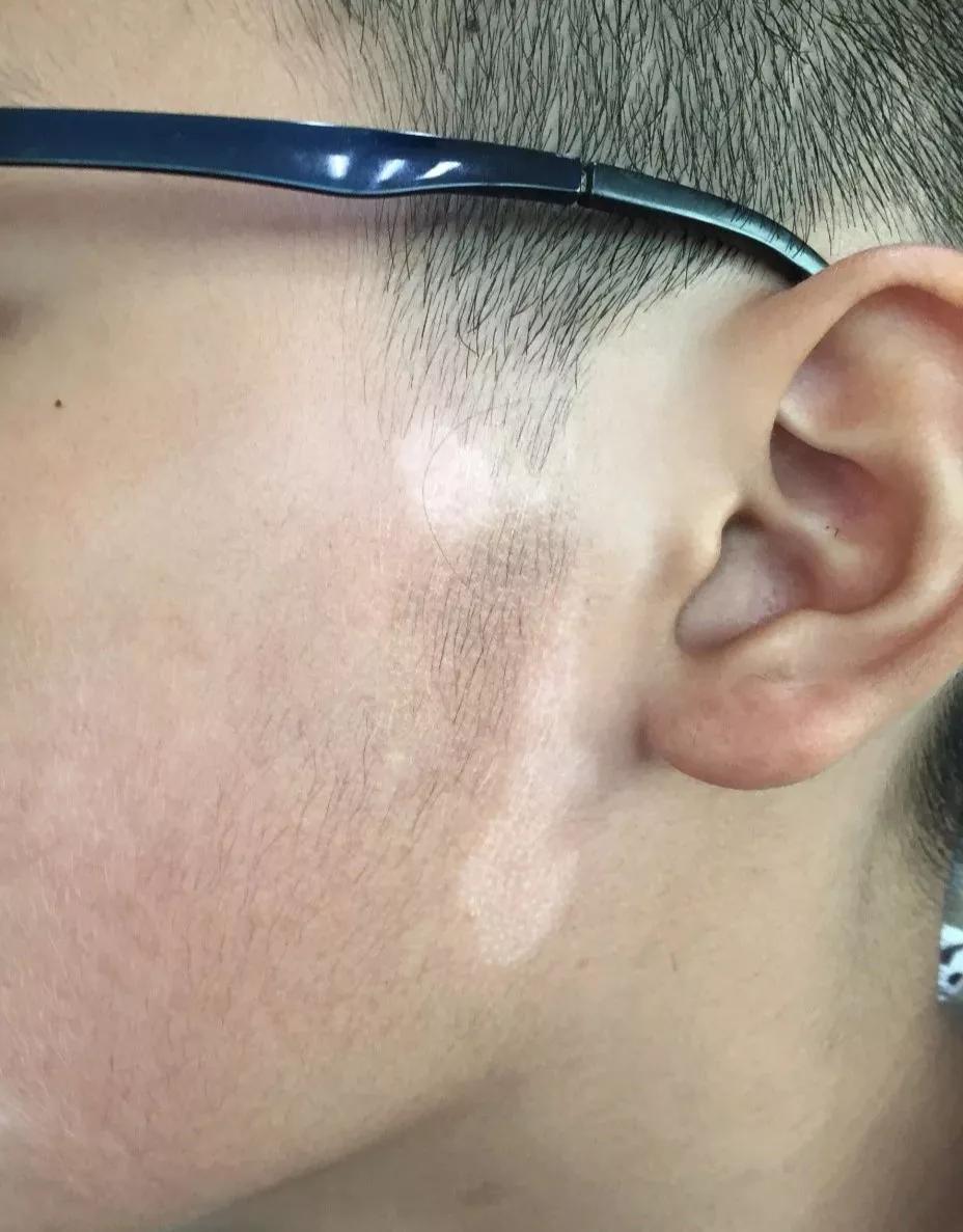 儿童治疗白癜风需要多少钱,uvb治疗白癜风多久见效