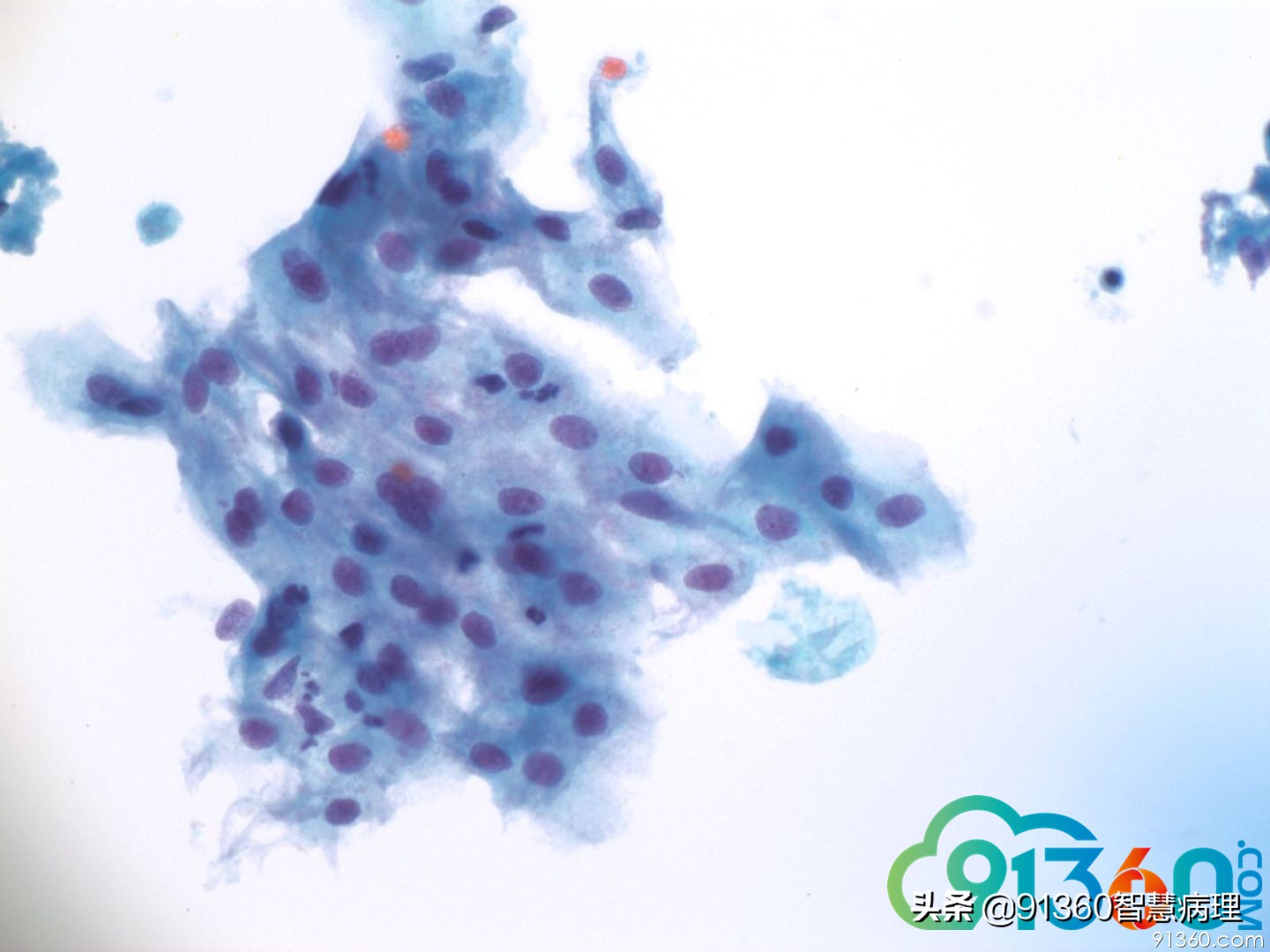 宫颈病理tct是什么检查,tct出现ascus会是宫颈癌吗